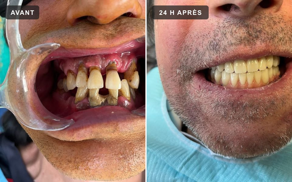 Dents très abîmées avant l'intervention, puis bridge provisoire fixe 24 heures après