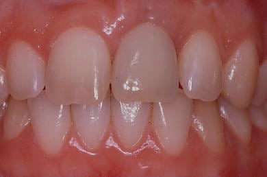 Couronne posée sur l'implant