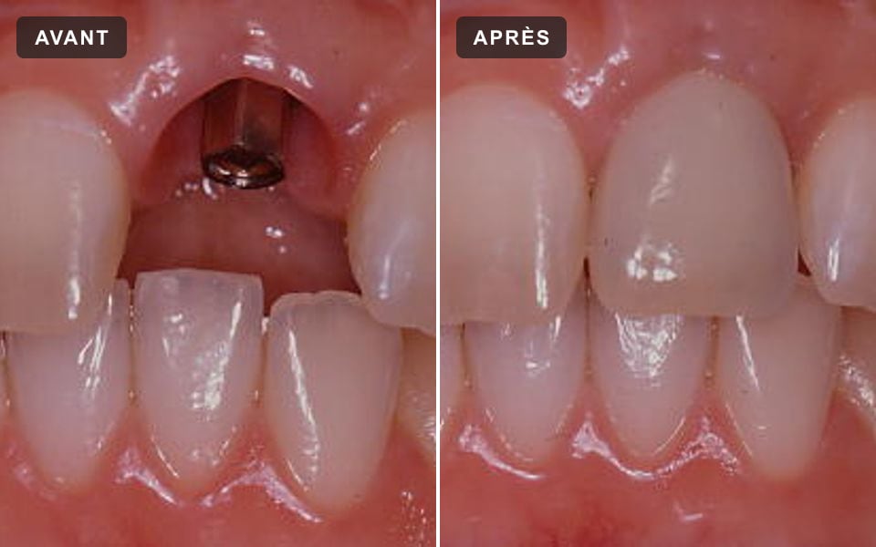 Incisive remplacée par un implant, avant et après la pose de la couronne