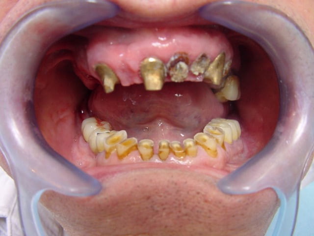 Dents très abîmées avant le traitement