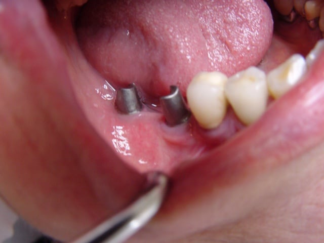 Deux piliers sur implants dans le secteur latéral
