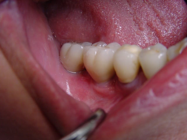 Bridge scellé sur les deux implants
