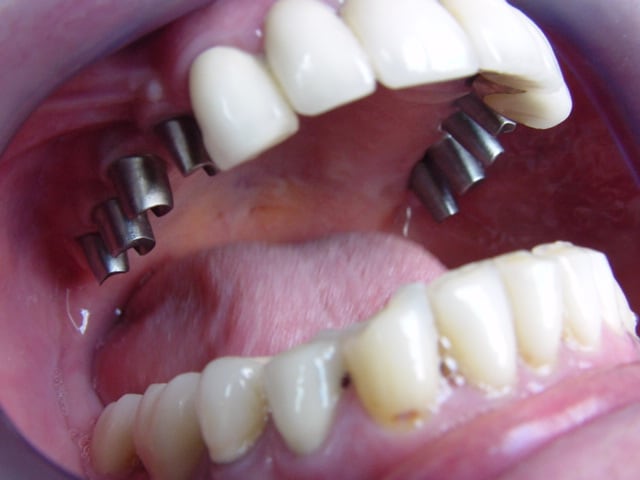 Piliers sur implants au maxillaire et à la mandibule