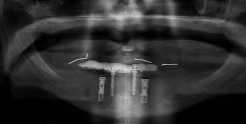 Radiographie panoramique avec les implants définitifs et provisoires
