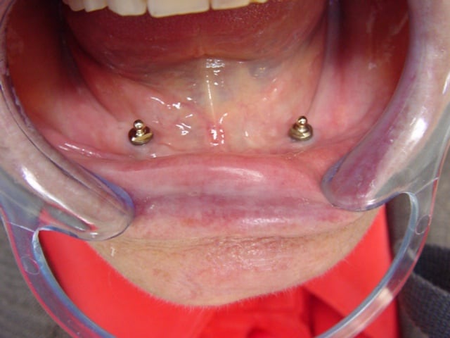 Attachements boules vissés sur les implants