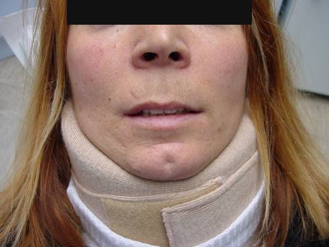 La patiente avant le traitement, les yeux masqués