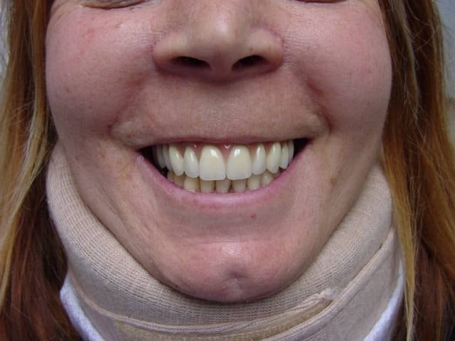 Le sourire de la patiente avec son bridge
