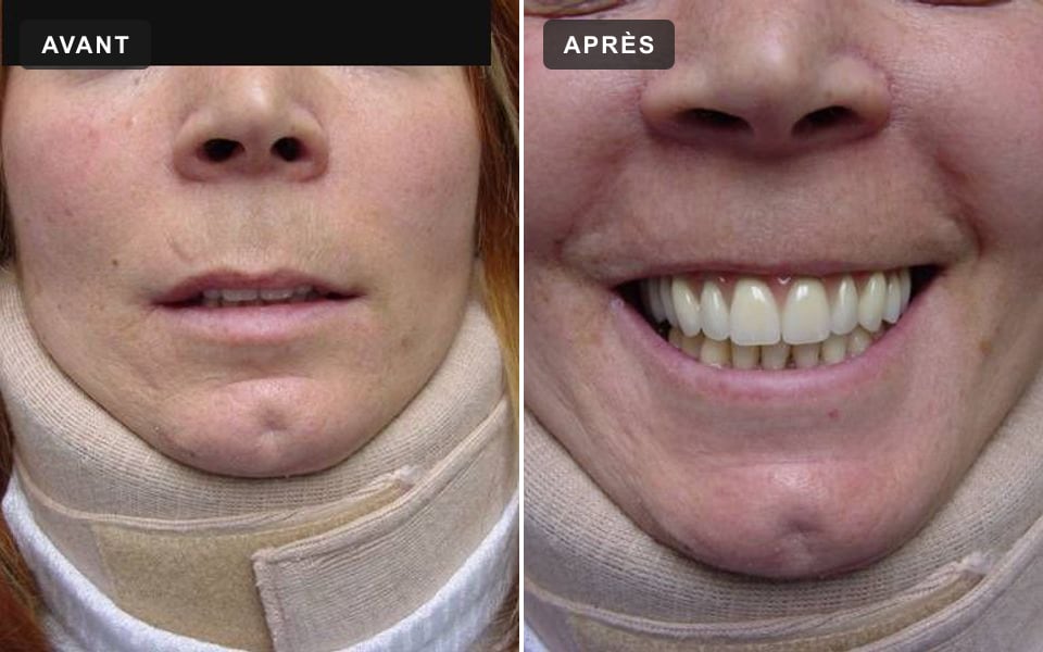 Sourire d'une patiente avant et après son bridge, les yeux masqués