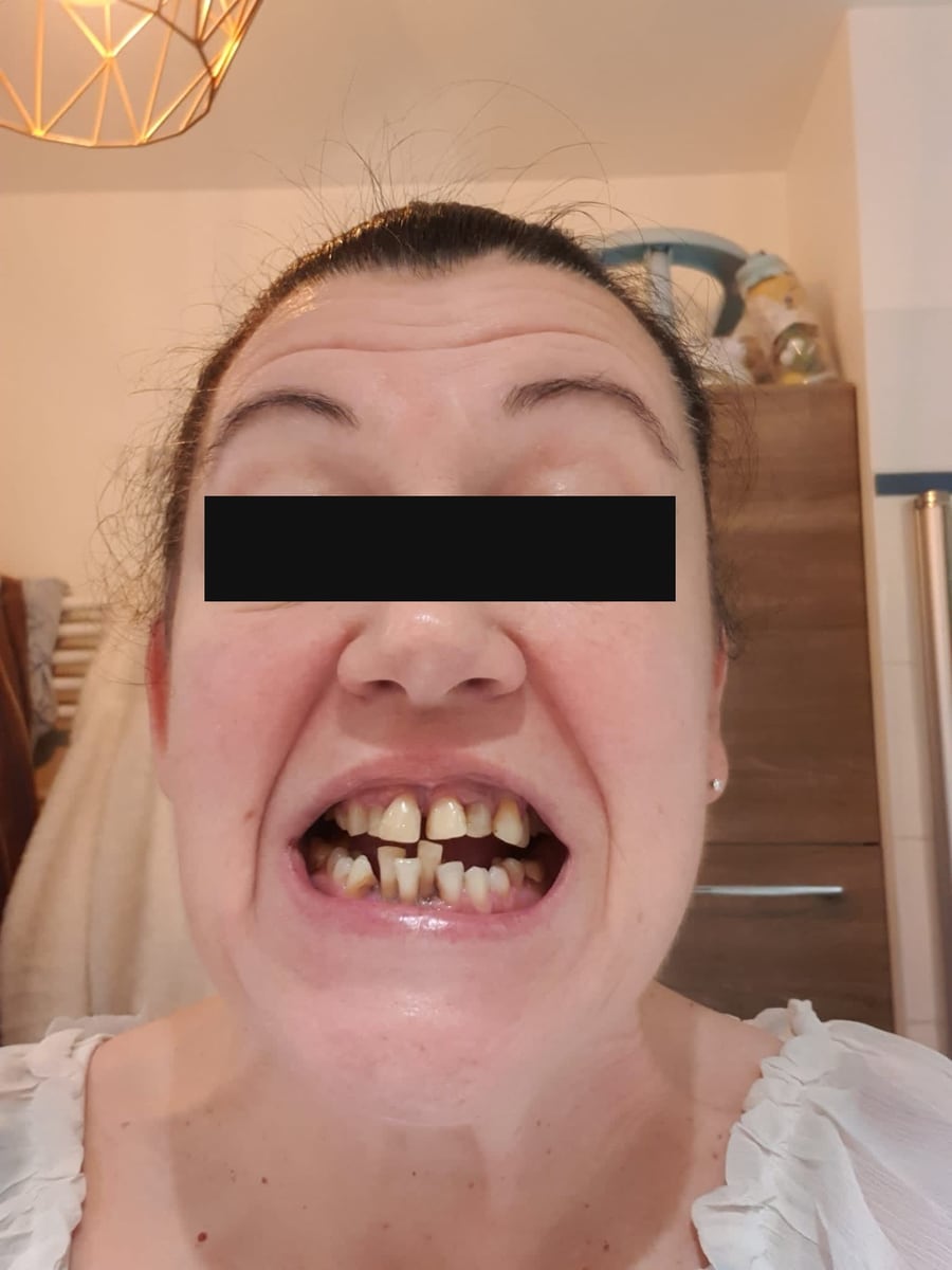 La patiente avant le traitement, les yeux masqués