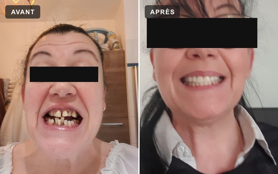 Sourire d'une patiente avant et après le traitement, les yeux masqués