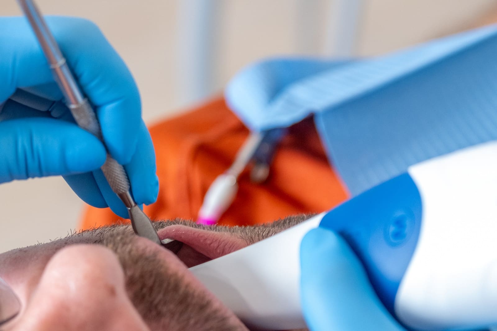 Empreinte numérique par scanner intra-oral pour aligneurs Invisalign